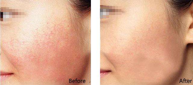 红血丝形成的原因4招让面部红血丝彻底消除