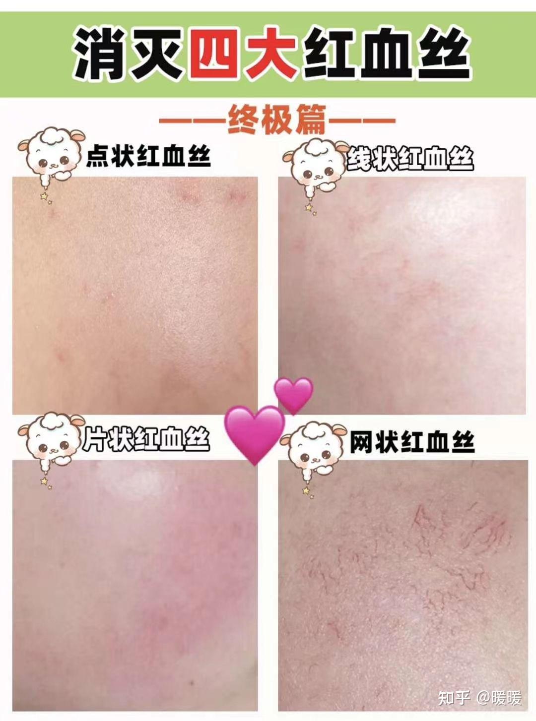 这4个部位长出红血丝赶紧去医院!拖着不管该生大病了